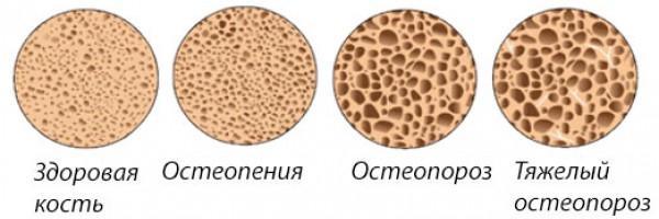 Этапы&nbsp;развития остеопороза
