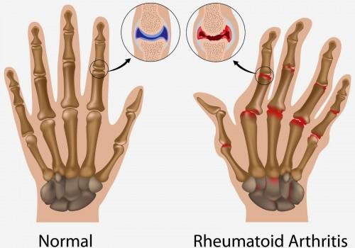 Артроз кистей
